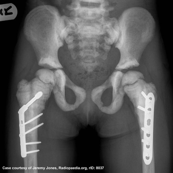 X-Ray image of Osteopetrosis patient